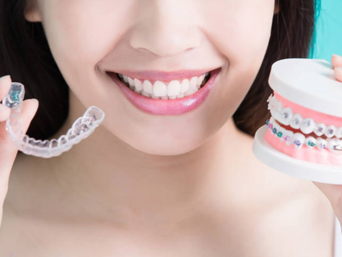 Aparelhos Ortodônticos: Qual a Melhor Opção para Você? (Convencional x Estético x Invisalign)